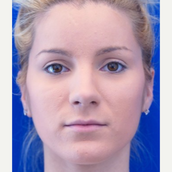 18-24 year old woman treated with Lip Augmentation before 3716253