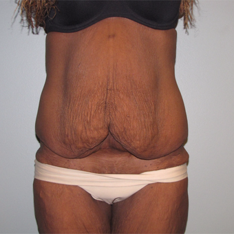 55-64 year old woman treated with Panniculectomy after 3691279