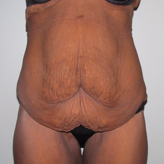 55-64 year old woman treated with Panniculectomy before 3691279
