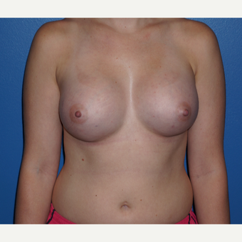 25-34 year old woman treated with Breast Augmentation after 3326126