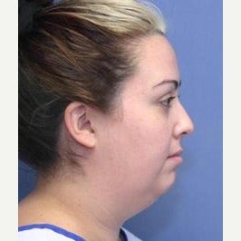 25-34 year old woman treated with Chin Liposuction before 2034356