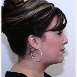25-34 year old woman treated with Chin Liposuction after 2034356