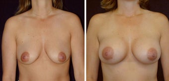 28 year old female, breast augmentation before 628312