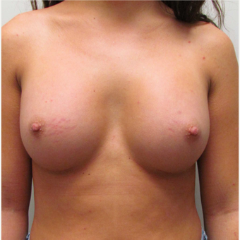 Gummy Bear Breast Augmentation for this 19 Year Old Woman after 3791785