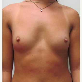 Gummy Bear Breast Augmentation for this 19 Year Old Woman before 3791785
