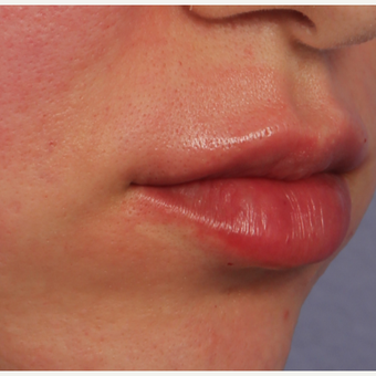 25-34 year old woman treated with Restylane Silk after 3666254