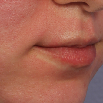 25-34 year old woman treated with Restylane Silk before 3666254