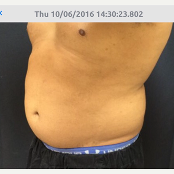 35-44 year old man treated with SculpSure after 3544444