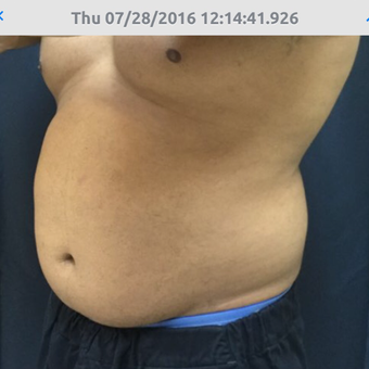 35-44 year old man treated with SculpSure before 3544444