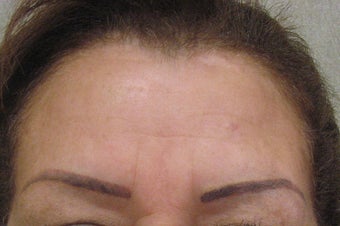 Botox after 479027