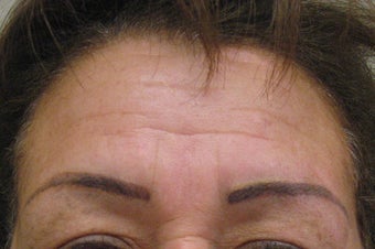 Botox before 479027