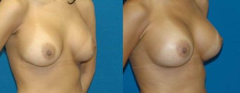 Saline, High Profile, Submuscular 550 before 1076147