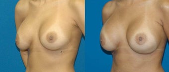 Saline, High Profile, Submuscular 550 after 1076147