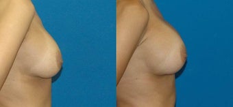 Saline, High Profile, Submuscular 550 1076147