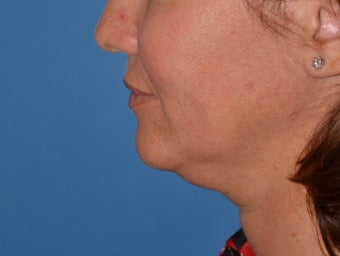SmarLipo to neck on female before 1260423