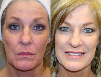 Liquid Facelift with Botox and Restylane before 1454063