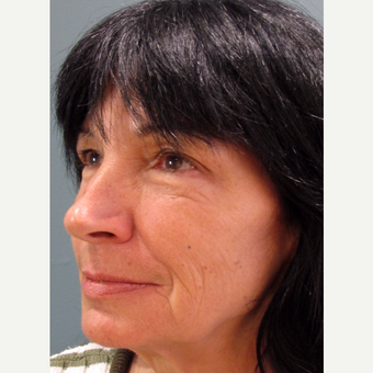 55-64 year old woman treated with Cheek Augmentation after 3713478