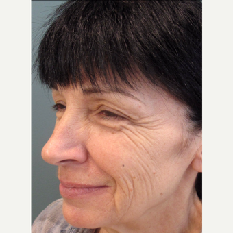 55-64 year old woman treated with Cheek Augmentation before 3713478