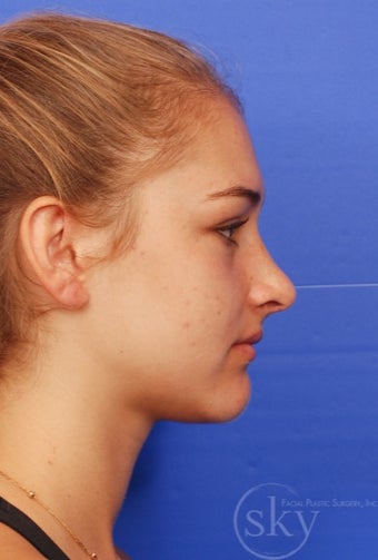 Rhinoplasty - Cosmetic after 3093652