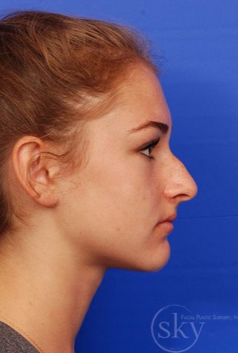 Rhinoplasty - Cosmetic before 3093652