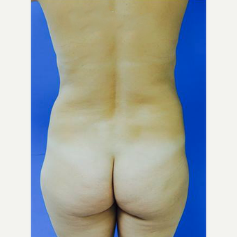 35-44 year old woman treated with Brazilian Butt Lift with PRP before 3107887