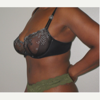 35-44 year old woman treated with Tummy Tuck after 3666261