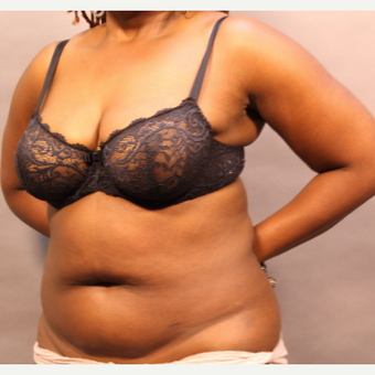 35-44 year old woman treated with Tummy Tuck before 3666261