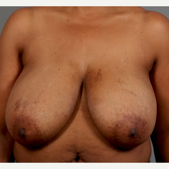 35-44 year old woman treated with Breast Reduction before 3495312