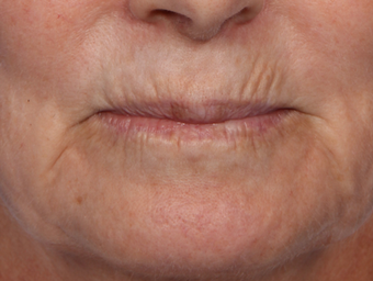 Botox before 302266
