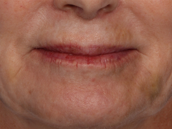 Botox after 302266