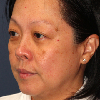 53 year old woman treated with Fraxel Dual and q-switched alex laser for age spots before 3616551