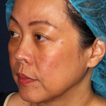 53 year old woman treated with Fraxel Dual and q-switched alex laser for age spots after 3616551