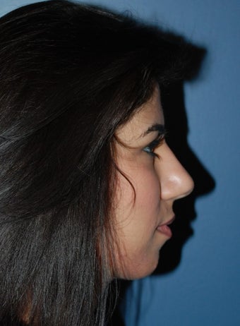 Rihinoplasty 1259206