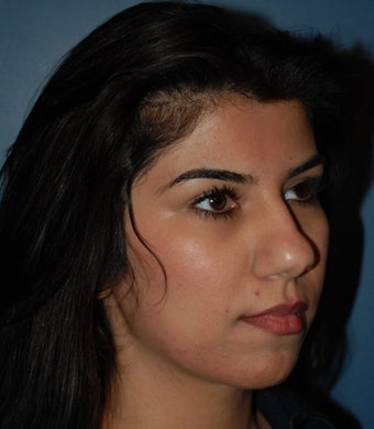 Rihinoplasty before 1259206