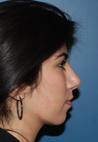 Rihinoplasty 1259206