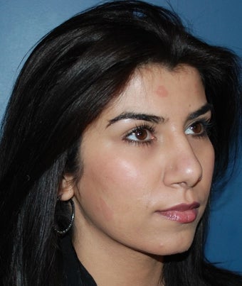 Rihinoplasty after 1259206