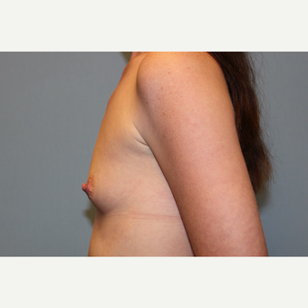 25-34 year old woman treated with Breast Augmentation before 3569942