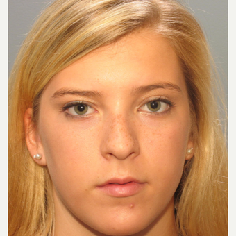 Woman 17 years old or younger treated with Rhinoplasty before 3410869