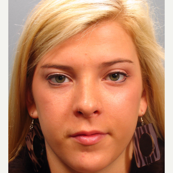 Woman 17 years old or younger treated with Rhinoplasty after 3410869