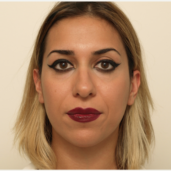 25-34 year old woman treated with Rhinoplasty before 3406454