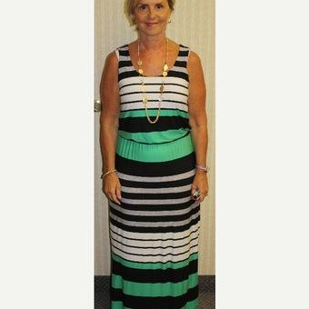 45-54 year old woman treated with Sleeve Gastrectomy after 2026440