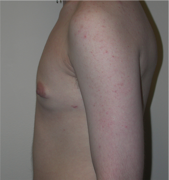 Young Man Undergoes Top Surgery as part of a Female to Male Transformation 1190957
