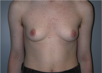 Young Man Undergoes Top Surgery as part of a Female to Male Transformation before 1190957