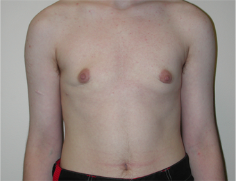 Young Man Undergoes Top Surgery as part of a Female to Male Transformation after 1190957