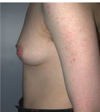 Young Man Undergoes Top Surgery as part of a Female to Male Transformation 1190957