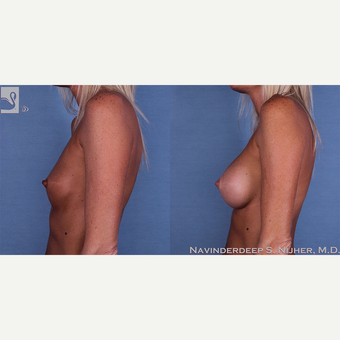 35-44 year old woman treated with Breast Augmentation after 3770038