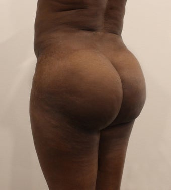 25-34 year old woman treated with Butt Lift after 2062995