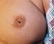 23 year old female patient before 933181