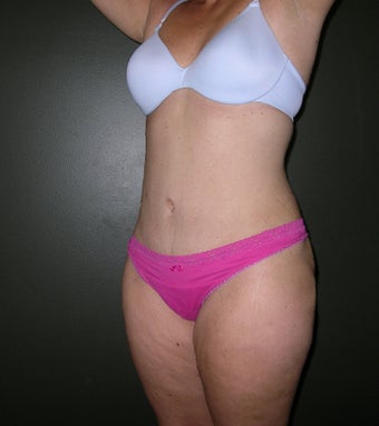 Tummy tuck with Flank Liposuction 1208044