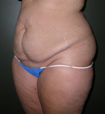 Tummy tuck with Flank Liposuction 1208044